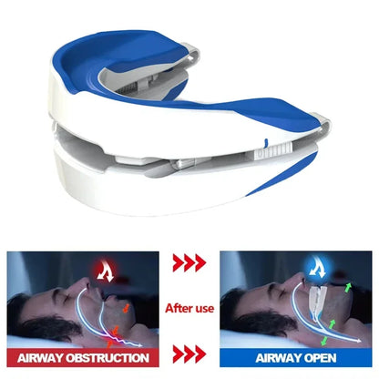 Anti-Snoring Mouthpiece