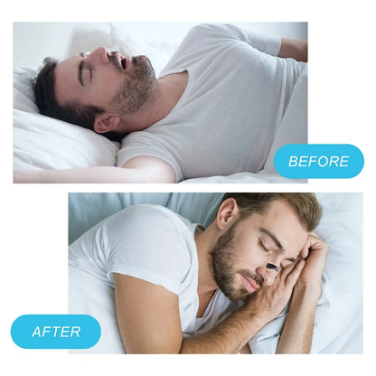 Nasal Breathing Dilators Starter Kit